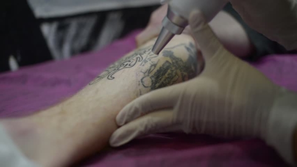 How Long Does a Laser Tattoo Removal Session Last?