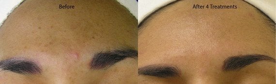 hyperpigmentation