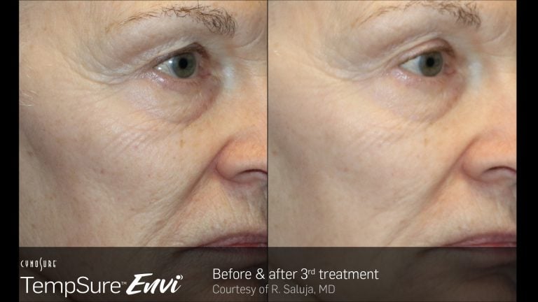 skin tightening nyc