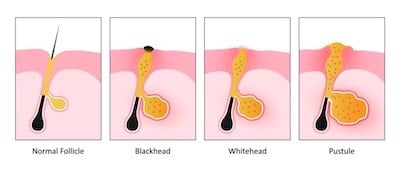 diagram showing stages of acne inflammation and infection