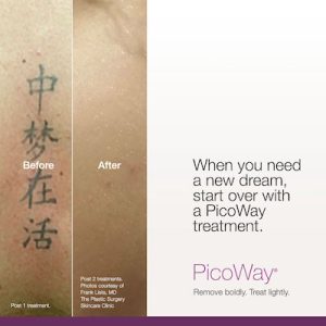 Picoway Tattoo Removal In Nyc