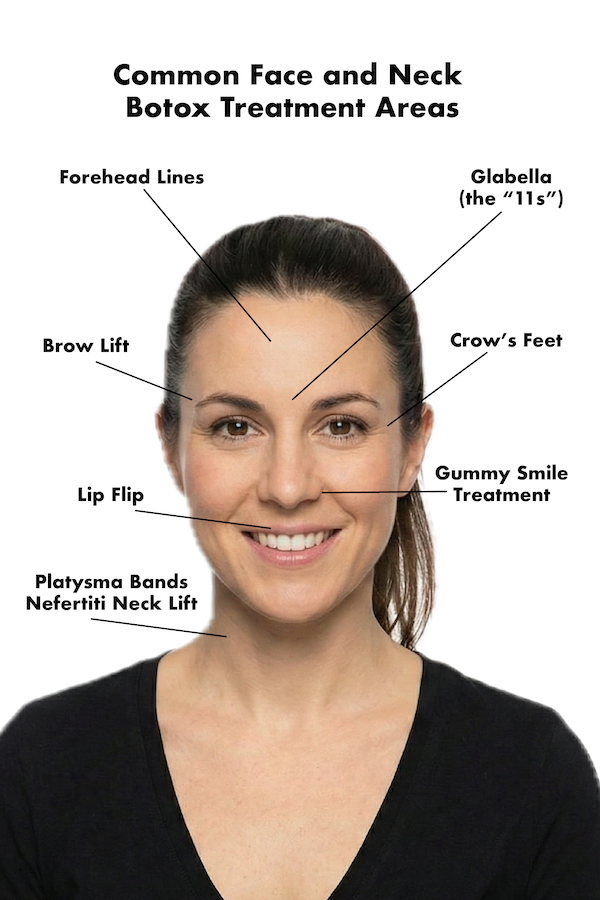 Diagram showing Botox Treatment Areas we use in our Manhattan practice on a woman's face.