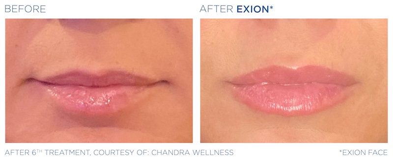 Exion Lips 1