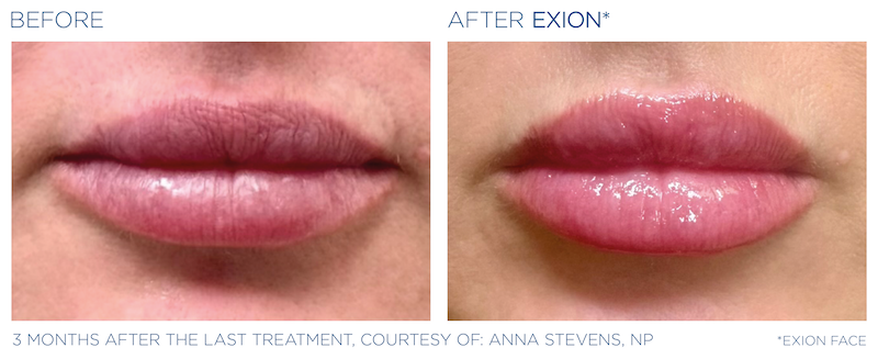 Exion Lips 3