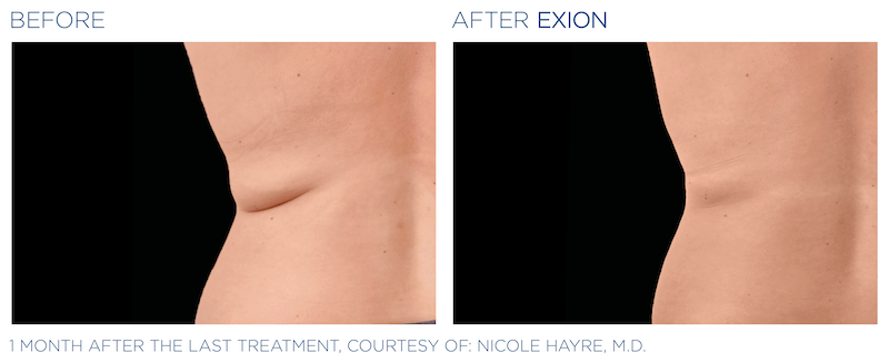 Exion Love Handles 1