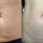 Rf Microneedling Before And After 2