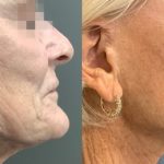 Rf Microneedling Before And After 3