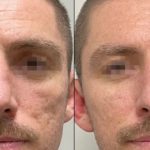 Rf Microneedling Before And After 4