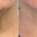 Rf Microneedling Before And After 5