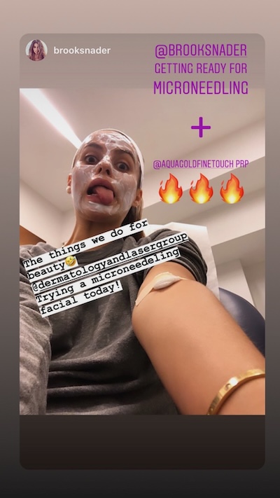 Celebrity patient Brooks Nader getting PRP microneedling treatment at The Dermatology and Laser Group in NYC