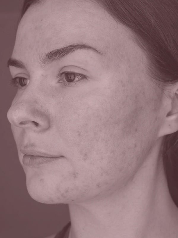 Patient with acne seeking medical dermatology treatment at The Dermatology and Laser Group in New York City