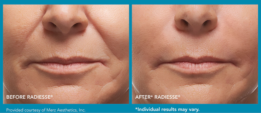 Before and After Image of a Woman after Radiesse