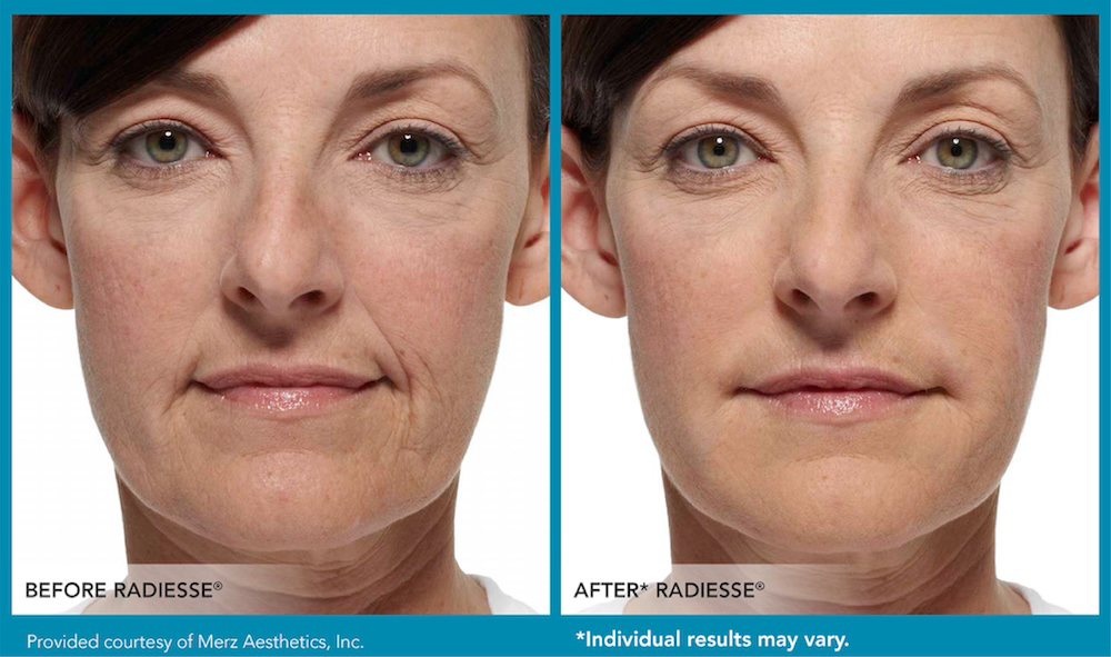 Before and After Image of a Woman after Radiesse