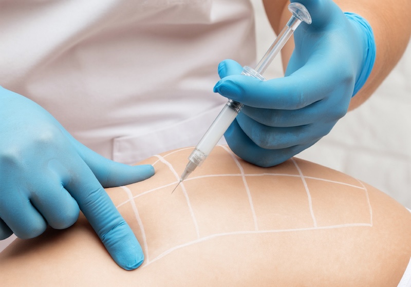 Woman Getting Injections of Sculptra for Butt Lift