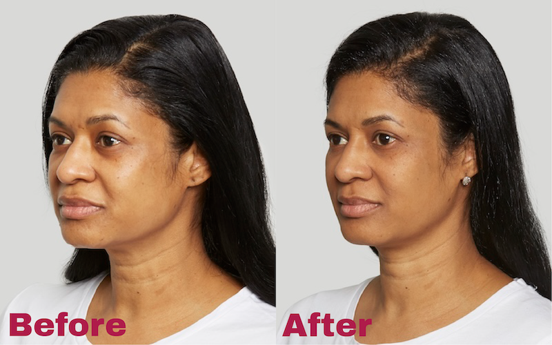 Sculptra Before And After Image