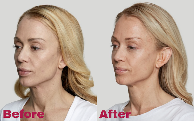 Sculptra Before And After Image