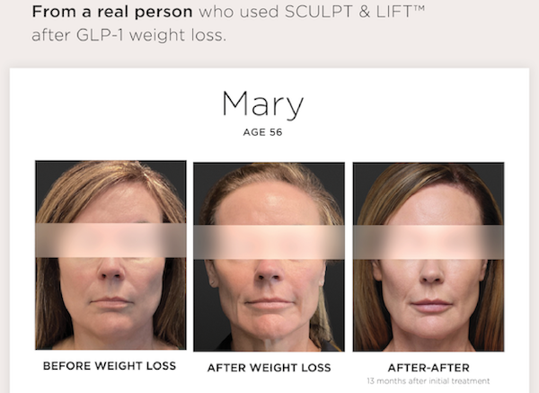 3 images of the same woman. One showing the woman at rest, second after weith loss with a GLP-1, and the third after Sculptra.