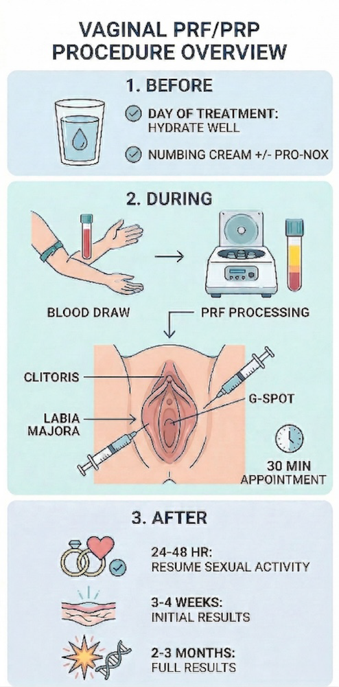 Diagram showing Steps For Vaginal Prp procedure